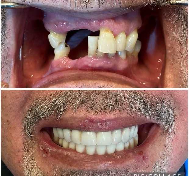 Smile Core Dental patient with severe bone loss and missing teeth, before and after full-arch implant restoration