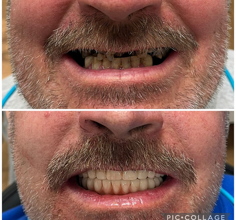 A Smile Core Dental patient's full-arch implant transformation