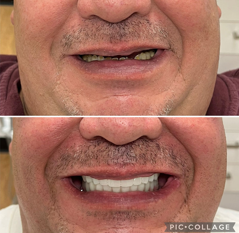 Before and after — actual patient of Dr. Matthew Jensen · Upper and lower All-On-X