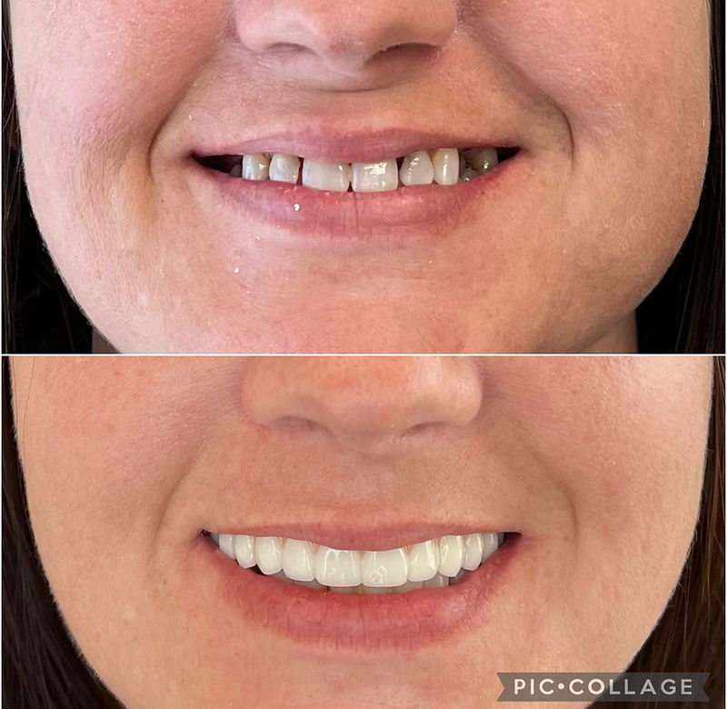 Before and after — actual patient of Dr. Matthew Jensen · Upper All-On-X