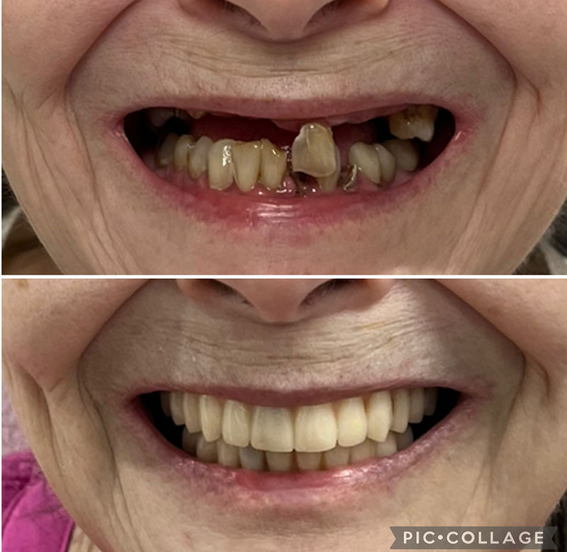 Before and after — actual patient of Dr. Matthew Jensen · All-On-4 dental implants in Phoenix